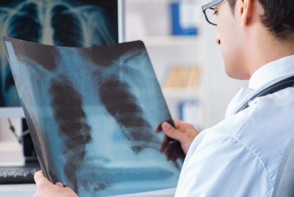 Lungenkrebsvorsorge: Arzt analysiert Röntgenbild von Lunge